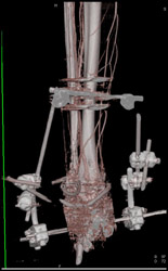 CTA of Lower Extremities - CTisus CT Scan