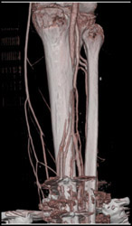 Normal CTA - CTisus CT Scan