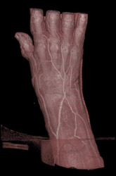 CTA Hand - CTisus CT Scan