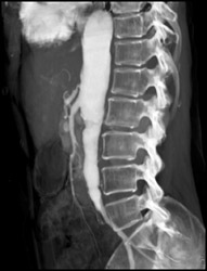 Stenosis of Celiac Artery - CTisus CT Scan