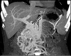 Cavernous Transformation of the Portal Vein (CTPV) - CTisus CT Scan