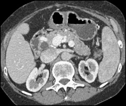 Collaterals Simulate A Pancreatic Mass - CTisus CT Scan