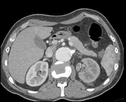 Decreased Function Left Kidney - CTisus CT Scan