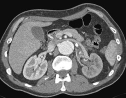 Aortic Dissection With Decreased Left Renal Function - CTisus CT Scan