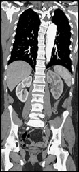 Decreased Left Renal Function - CTisus CT Scan