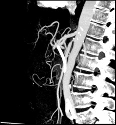 Superior Mesenteric Artery (SMA) Stenosis - CTisus CT Scan