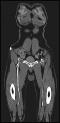 Occluded Left SFA - CTisus CT Scan