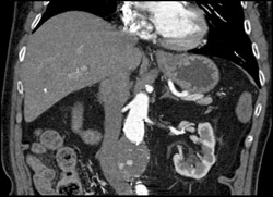 Leaking Abdominal Aortic Aneurysm (AAA) Near Graft - CTisus CT Scan