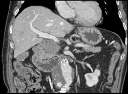 Pancreatic Mass With Incidental Endoleak - CTisus CT Scan