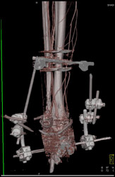 CTA in Trauma Patient - CTisus CT Scan