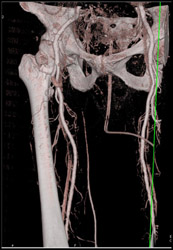 Normal Femoral and Popliteal Arteries - CTisus CT Scan