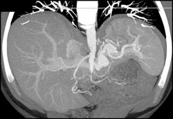 Splenic Artery Aneurysm - CTisus CT Scan