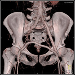 Fem-fem Bypass Graft With Occluded Right Common Iliac Artery - CTisus CT Scan