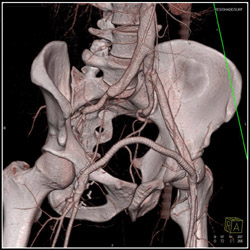 Fem-fem Graft - CTisus CT Scan