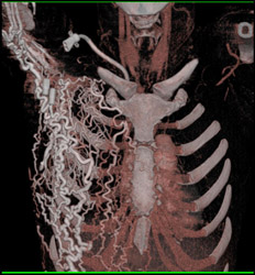 Collaterals in 3D - CTisus CT Scan