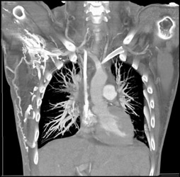 SVC Syndrome Due to Sarcoidosis - CTisus CT Scan