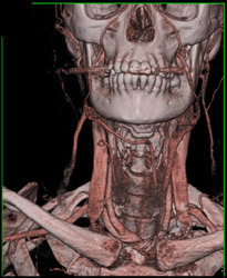 Normal Carotid Artery and Jugular Veins - CTisus CT Scan