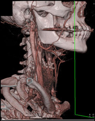 Normal Bifurcation - CTisus CT Scan