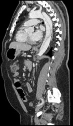 Type B Dissection - CTisus CT Scan