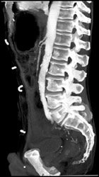 Stenosis of SMA - CTisus CT Scan