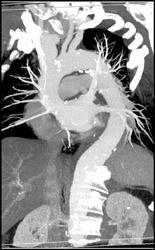 Dilated Subclavian Artery - CTisus CT Scan