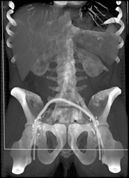 Fem-fem Bypass - CTisus CT Scan