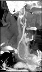 Carotid Artery Stenosis - CTisus CT Scan