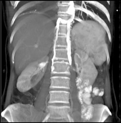 Prominent Collateral Veins - CTisus CT Scan