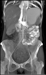 Left Renal Vein Into Inferior Vena Cava (IVC) - CTisus CT Scan