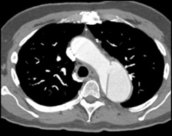 Aortic Dissection - CTisus CT Scan