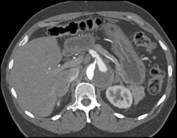 Aortic Dissection - CTisus CT Scan