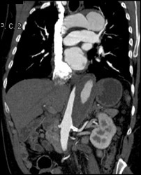 Aortic Dissection - CTisus CT Scan