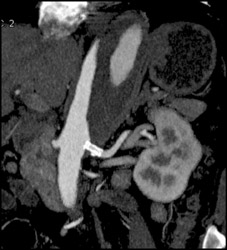 Aortic Dissection - CTisus CT Scan