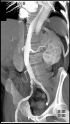 Aortic Dissection - CTisus CT Scan