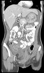 Superior Mesenteric Vein (SMV) Clot - CTisus CT Scan