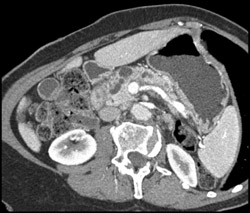 Patent SMV/PV - CTisus CT Scan