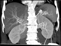 Splenic Artery Aneurysm - CTisus CT Scan