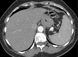 Splenic Artery Aneurysm - CTisus CT Scan