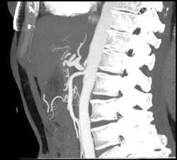 Median Arcuate Ligament Syndrome - CTisus CT Scan