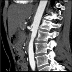 Median Arcuate Ligament Syndrome - CTisus CT Scan