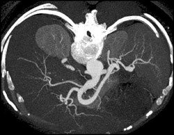 Celiac Artery Aneurysm - CTisus CT Scan