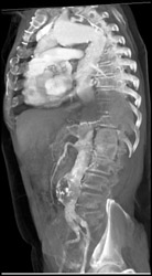 Aortic Aneurysm - CTisus CT Scan