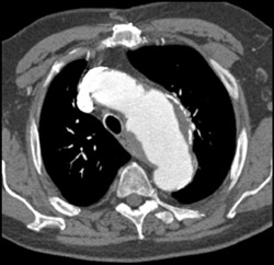 Aortic Aneurysm - CTisus CT Scan