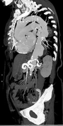 Ulcerations in Aorta - CTisus CT Scan