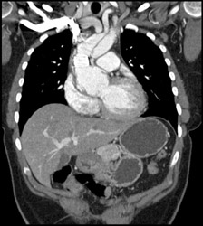 Aortic Dissection - CTisus CT Scan