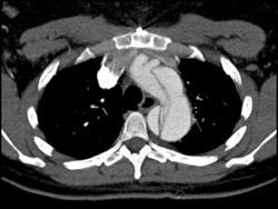 Aortic Dissection - CTisus CT Scan