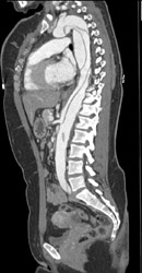 Aortic Dissection - CTisus CT Scan