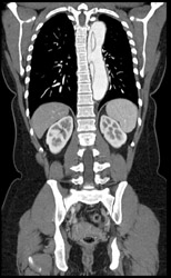 Aortic Dissection - CTisus CT Scan