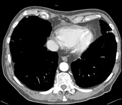 Pseudo Inferior Vena Cava (IVC) Clot - CTisus CT Scan