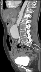 Abdominal Aortic Aneurysm (AAA) - CTisus CT Scan